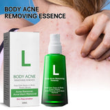 1 x Brand New Body Acne Serum For Removing Acne, Pimples And Acanthosis Nigricans,Exfoliating Acne Serum For Back And Body,Duo Acne Spot Cream With Double Action For Buttocks And Body - RRP €18.0